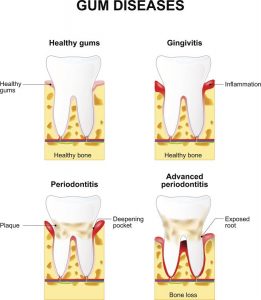 Gingivitis vs Periodontitis: What's the difference? - The Mommyhood ...